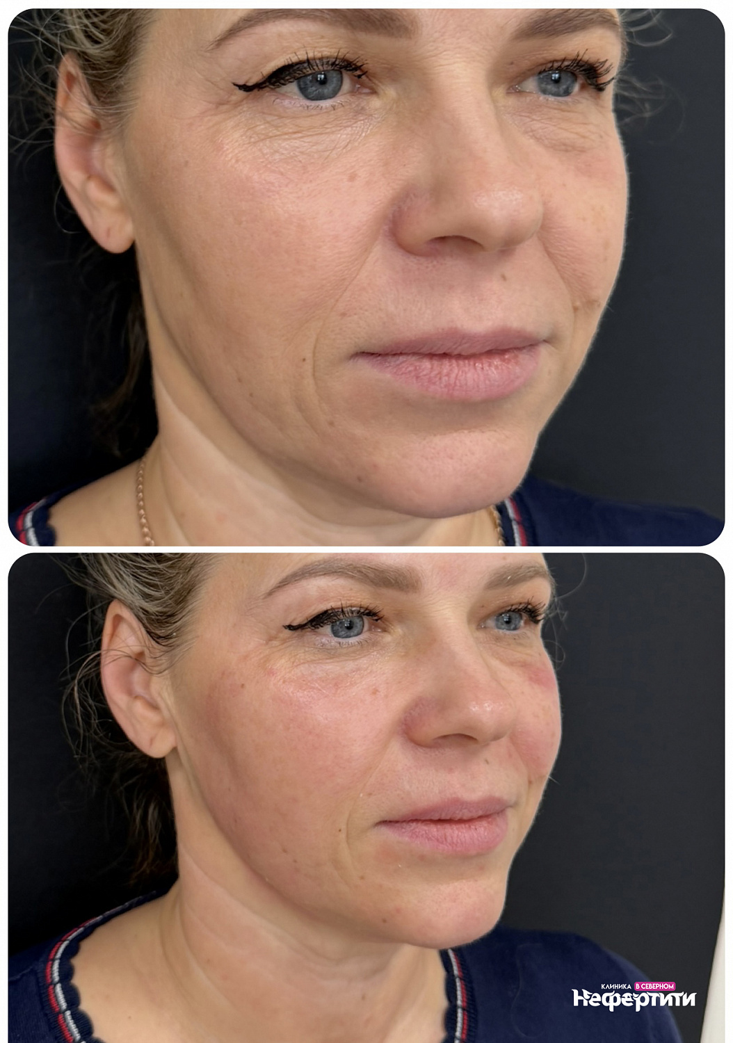 Volnewmer  — безоперационный лифтинг лица на монополярном RF 